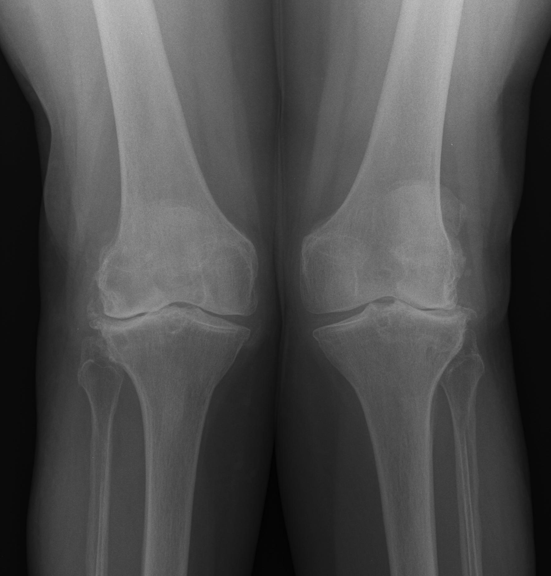 TKR Bilateral Valgus OA